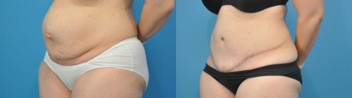 Before & After Abdominoplasty/Tummy Tuck Case 308 View #2 View in North Shore, IL