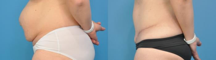 Before & After Abdominoplasty/Tummy Tuck Case 308 View #3 View in North Shore, IL