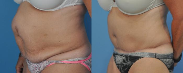 Before & After Abdominoplasty/Tummy Tuck Case 31 View #1 View in Northbrook, IL