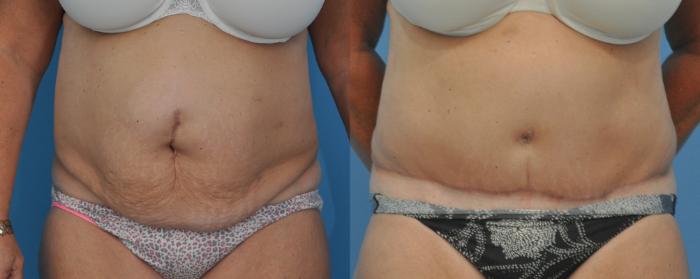 Before & After Abdominoplasty/Tummy Tuck Case 31 View #2 View in Northbrook, IL