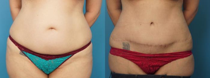 Before & After Abdominoplasty/Tummy Tuck Case 312 Front View in North Shore, IL