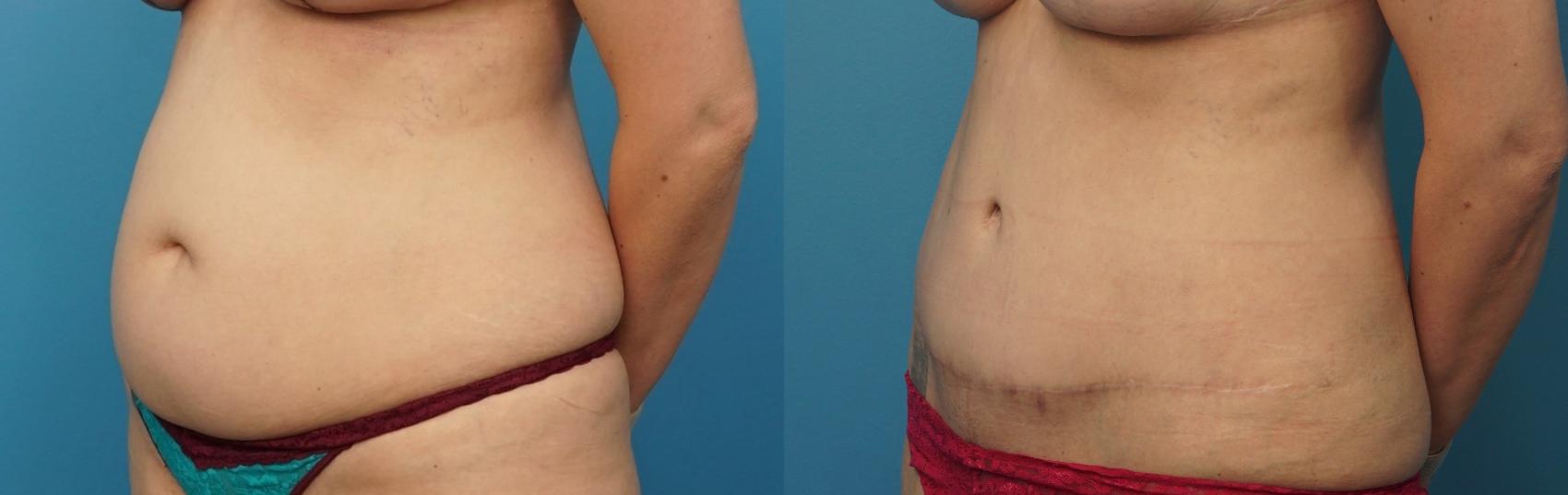 Before & After Abdominoplasty/Tummy Tuck Case 312 Left Oblique View in North Shore, IL