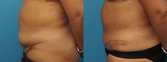 Before & After Abdominoplasty/Tummy Tuck Case 316 View #1 View in North Shore, IL