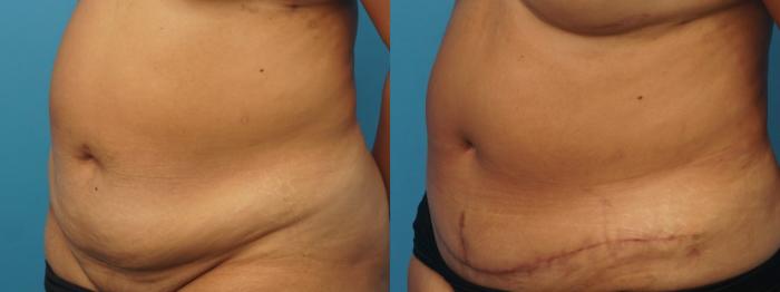 Before & After Abdominoplasty/Tummy Tuck Case 316 View #2 View in North Shore, IL