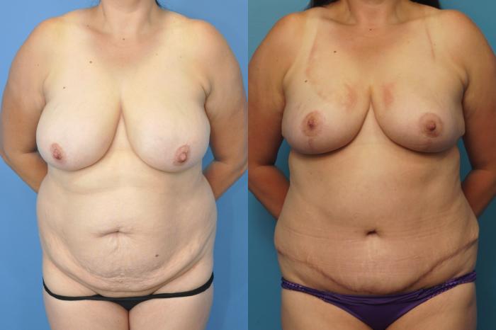 Before & After Breast Reduction Case 317 Front View in North Shore, IL