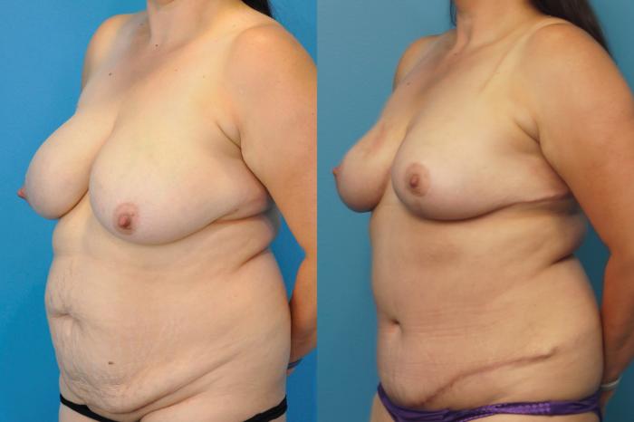 Before & After Breast Lift (Mastopexy) Case 317 Left Oblique View in North Shore, IL