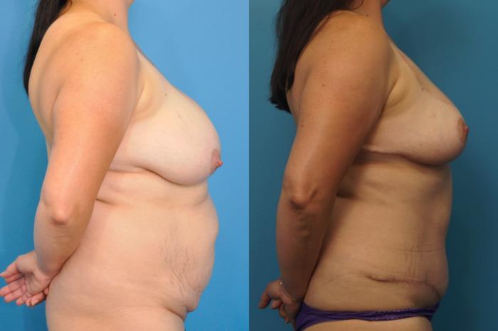 Before & After Breast Lift (Mastopexy) Case 317 Right Side View in North Shore, IL