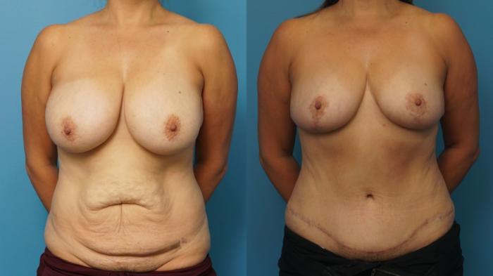 Before & After Breast Reduction Case 318 Front View in North Shore, IL