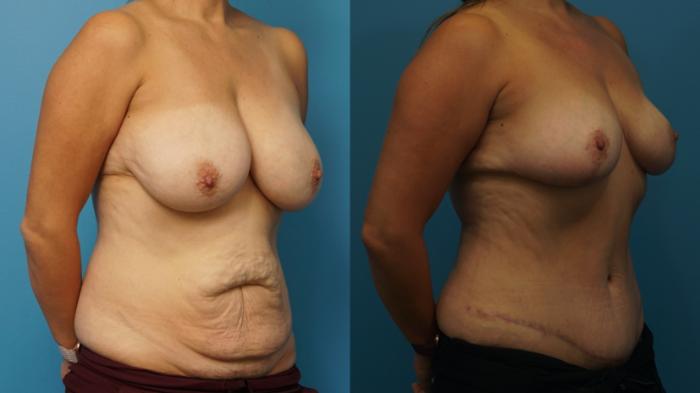 Before & After Breast Reduction Case 318 Right Oblique View in North Shore, IL