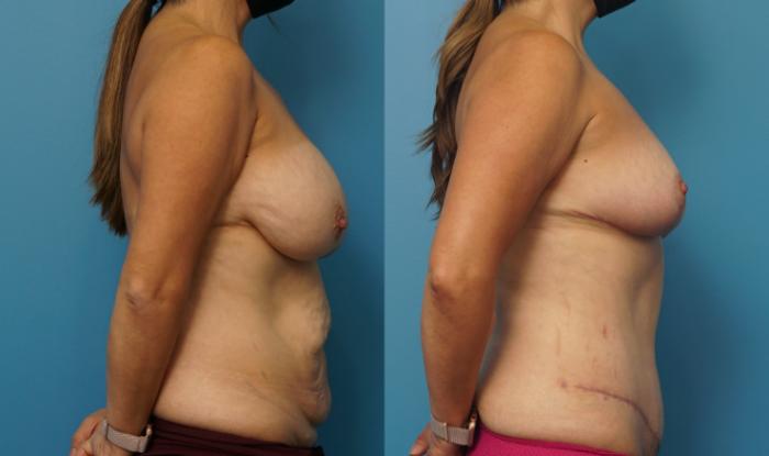 Before & After Breast Reduction Case 318 Right Side View in North Shore, IL
