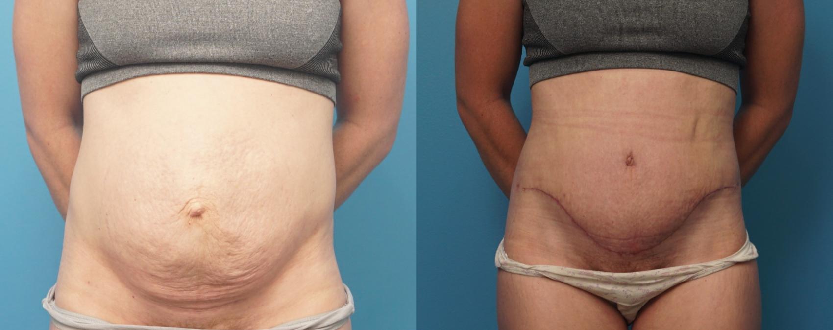 Before & After Abdominoplasty/Tummy Tuck Case 319 Front View in Northbrook, IL