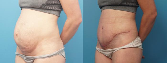 Before & After Abdominoplasty/Tummy Tuck Case 319 Left Oblique View in Northbrook, IL