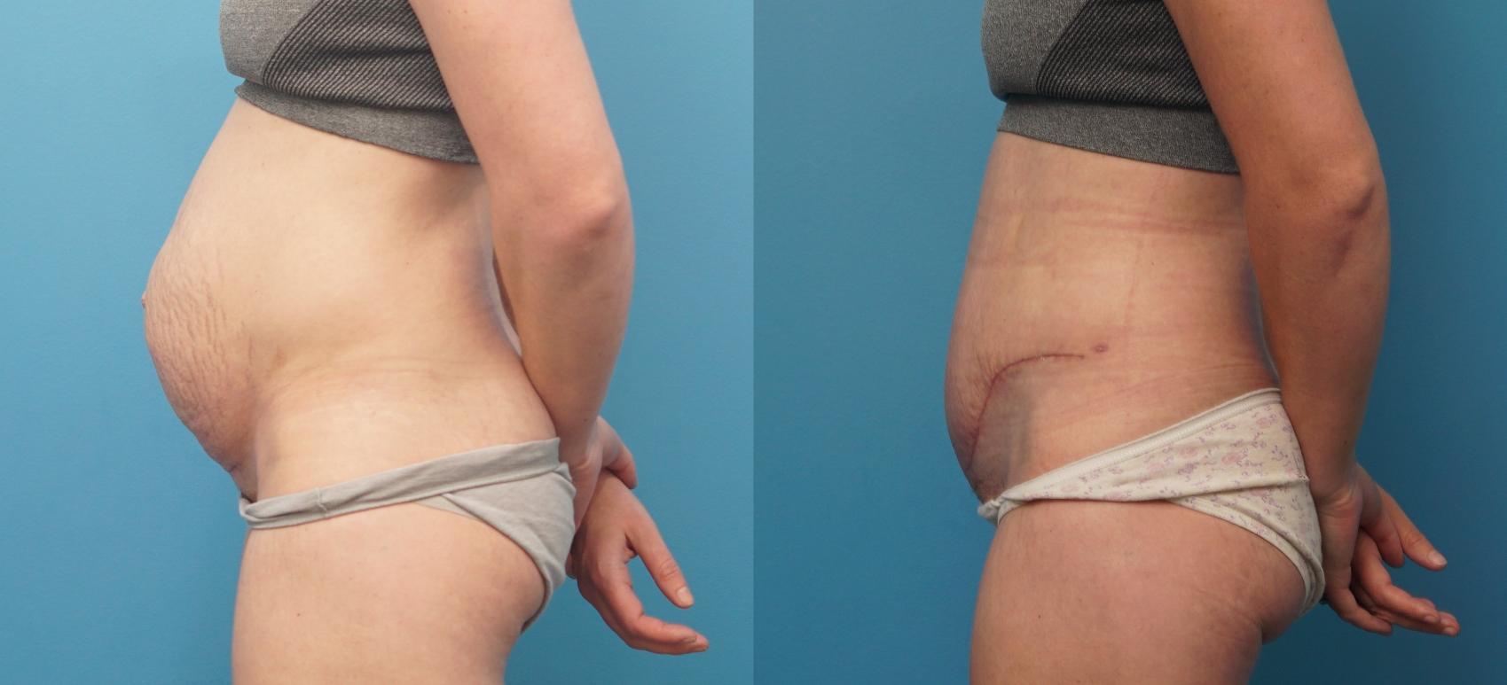 Before & After Abdominoplasty/Tummy Tuck Case 319 Left Side View in North Shore, IL