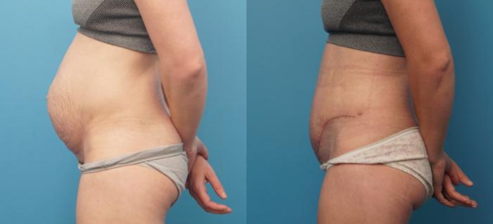 Before & After Abdominoplasty/Tummy Tuck Case 319 Left Side View in Northbrook, IL