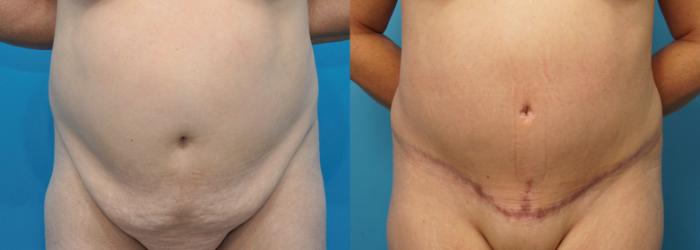 Before & After Abdominoplasty/Tummy Tuck Case 322 Front View in North Shore, IL