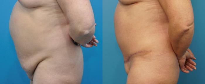 Before & After Abdominoplasty/Tummy Tuck Case 322 Left Side View in North Shore, IL