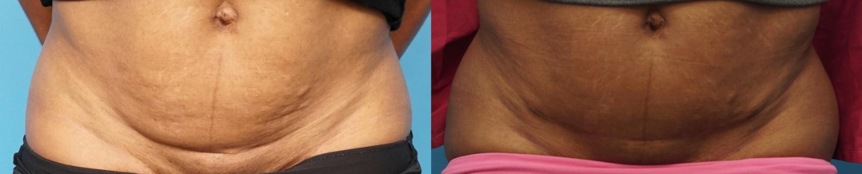 Before & After Abdominoplasty/Tummy Tuck Case 327 Front View in North Shore, IL