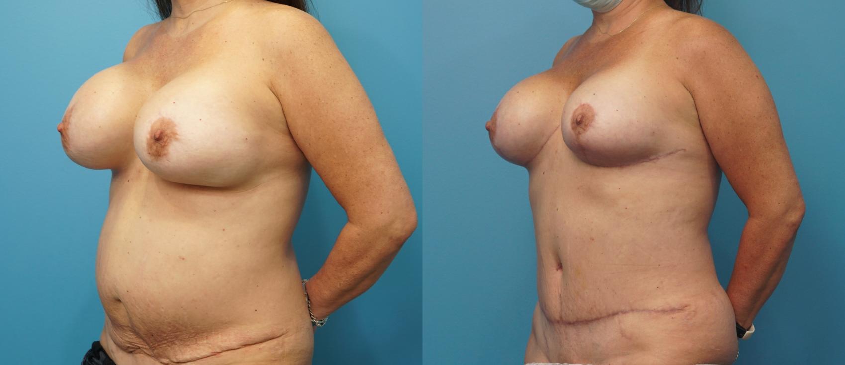 Before & After Breast Lift (Mastopexy) Case 328 Left Oblique View in North Shore, IL