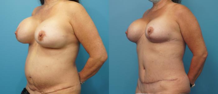 Before & After Breast Lift (Mastopexy) Case 328 Left Oblique View in Northbrook, IL