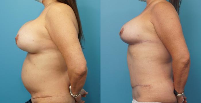 Before & After Breast Lift (Mastopexy) Case 328 Left Side View in North Shore, IL