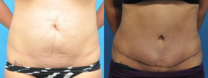 Before & After Abdominoplasty/Tummy Tuck Case 331 Front View in Northbrook, IL