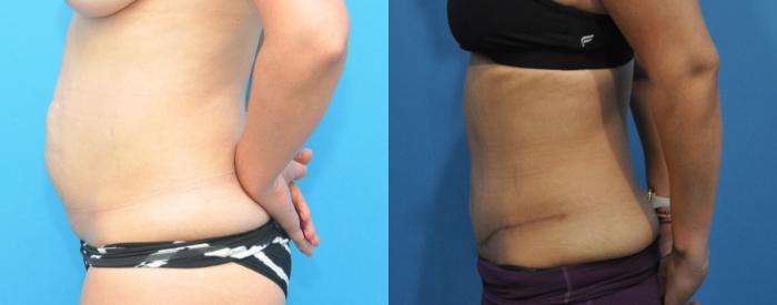 Before & After Abdominoplasty/Tummy Tuck Case 331 Left Side View in Northbrook, IL