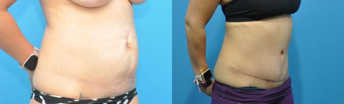 Before & After Abdominoplasty/Tummy Tuck Case 331 Right Oblique View in Northbrook, IL