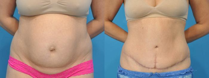 Before & After Abdominoplasty/Tummy Tuck Case 333 Front View in North Shore, IL