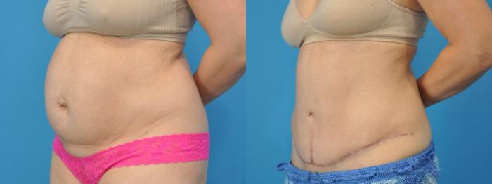 Before & After Abdominoplasty/Tummy Tuck Case 333 Left Oblique View in North Shore, IL