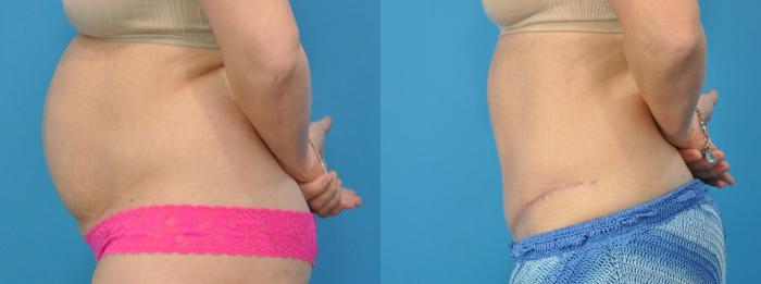 Before & After Abdominoplasty/Tummy Tuck Case 333 Left Side View in North Shore, IL
