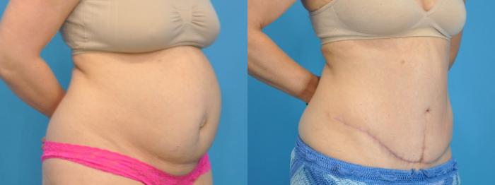 Before & After Abdominoplasty/Tummy Tuck Case 333 Right Oblique View in North Shore, IL