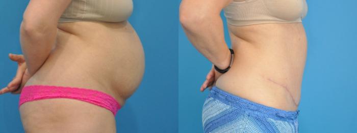 Before & After Abdominoplasty/Tummy Tuck Case 333 Right Side View in North Shore, IL