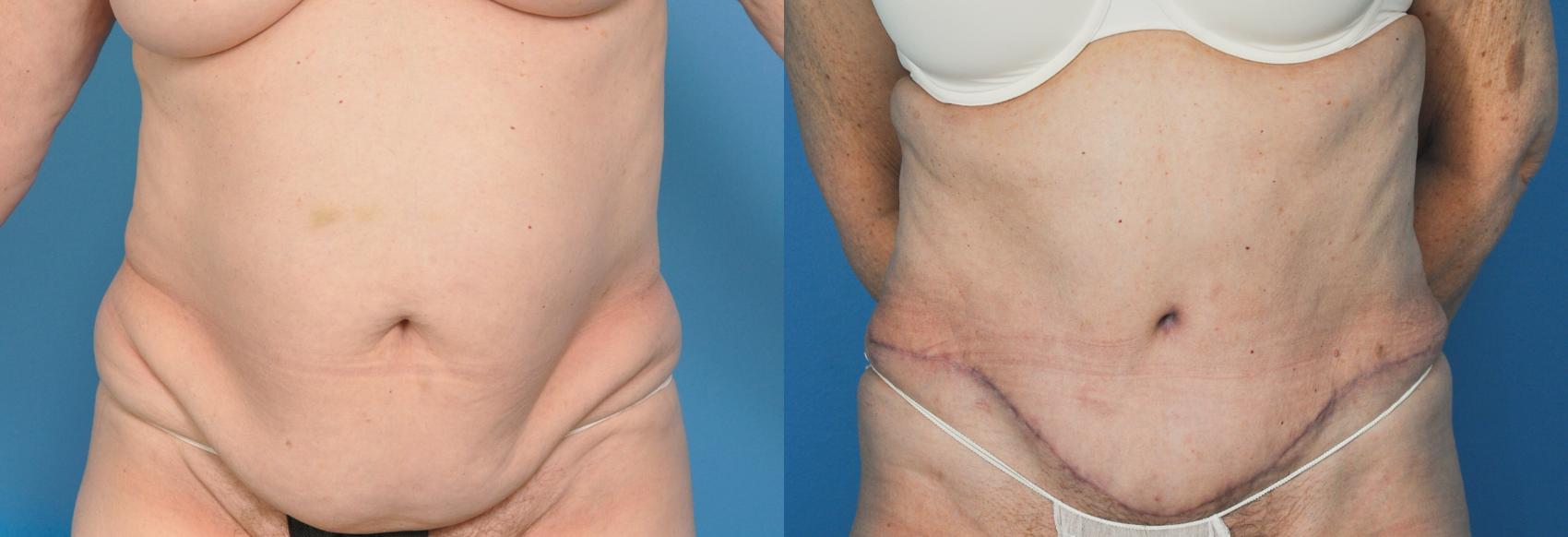 Before & After Abdominoplasty/Tummy Tuck Case 34 View #1 View in Northbrook, IL