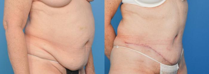 Before & After Abdominoplasty/Tummy Tuck Case 34 View #2 View in North Shore, IL