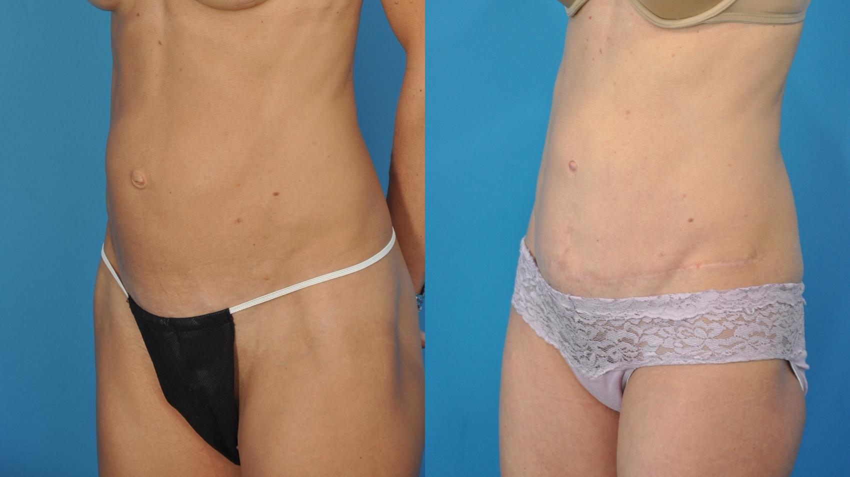 Before & After Abdominoplasty/Tummy Tuck Case 340 Left Oblique View in North Shore, IL