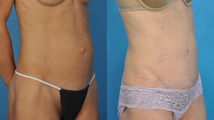 Before & After Abdominoplasty/Tummy Tuck Case 340 Right Oblique View in North Shore, IL