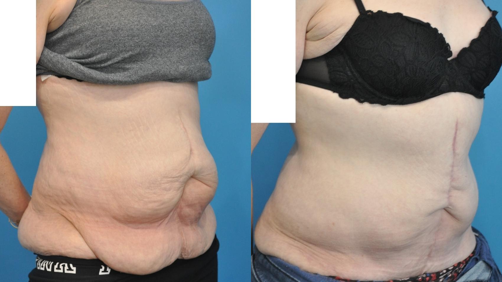 Before & After Abdominoplasty/Tummy Tuck Case 347 Left Oblique View in North Shore, IL