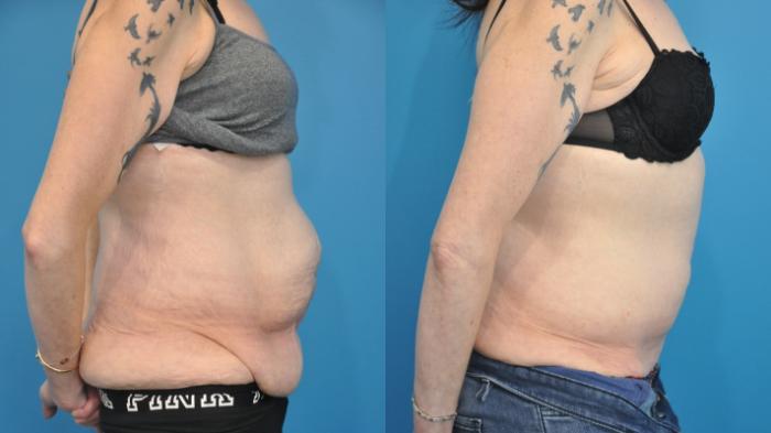 Before & After Abdominoplasty/Tummy Tuck Case 347 Right Side View in North Shore, IL