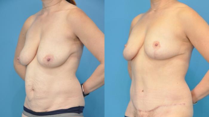 Before & After Mommy Makeover Case 353 Left Oblique View in North Shore, IL