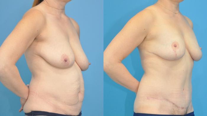 Before & After Mommy Makeover Case 353 Right Oblique View in North Shore, IL