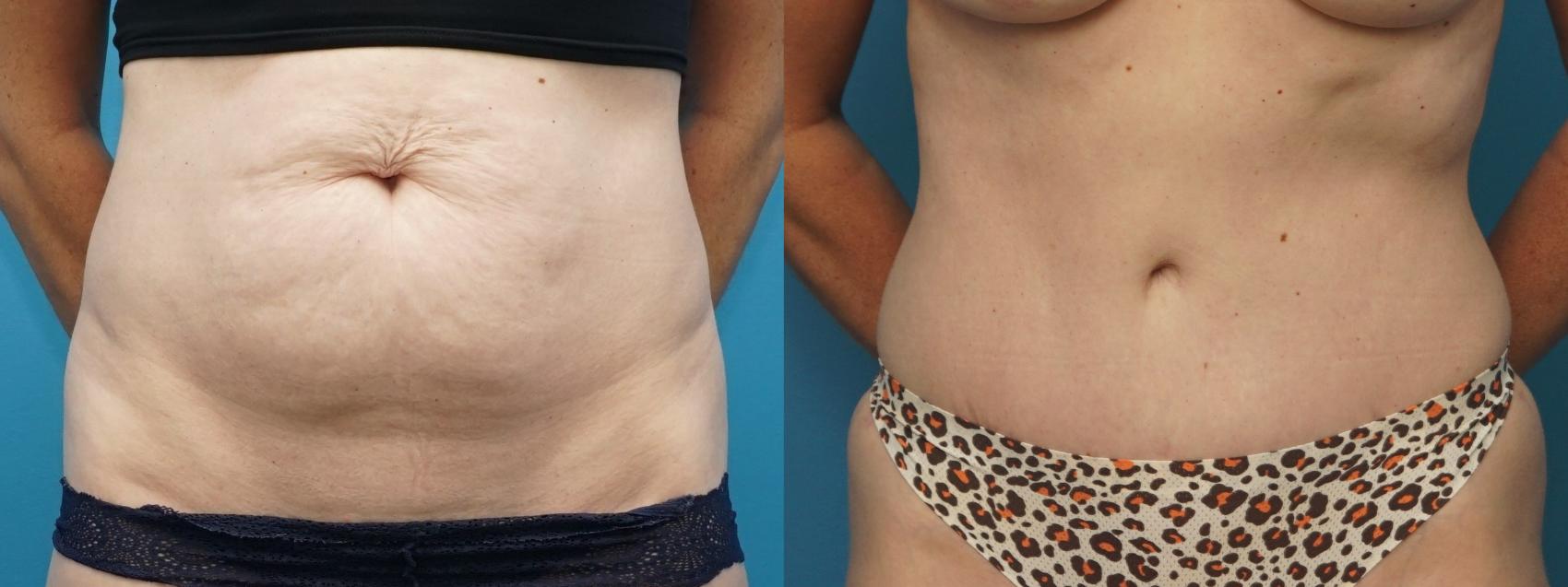 Before & After Abdominoplasty/Tummy Tuck Case 377 Front View in Northbrook, IL