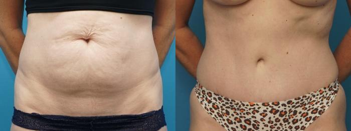 Before & After Abdominoplasty/Tummy Tuck Case 377 Front View in North Shore, IL
