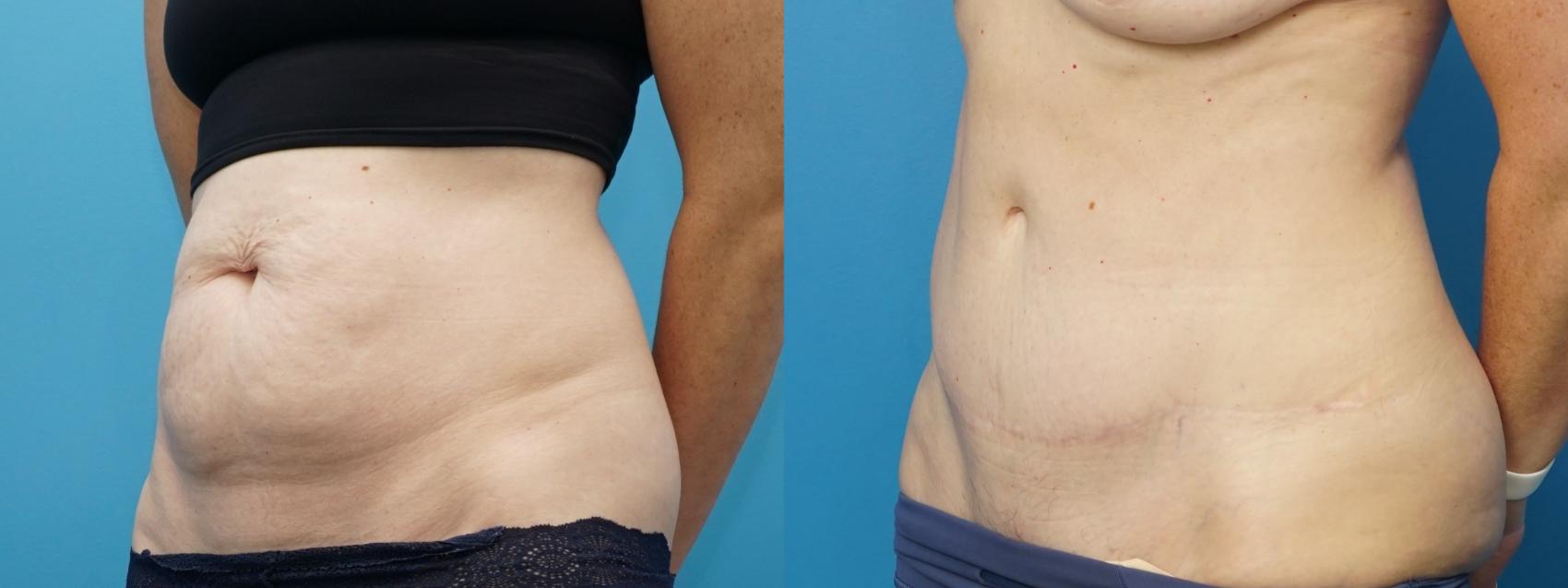 Before & After Abdominoplasty/Tummy Tuck Case 377 Left Oblique View in North Shore, IL