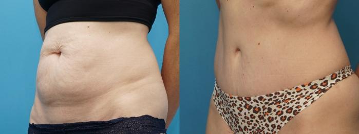 Before & After Abdominoplasty/Tummy Tuck Case 377 Left Oblique View in North Shore, IL