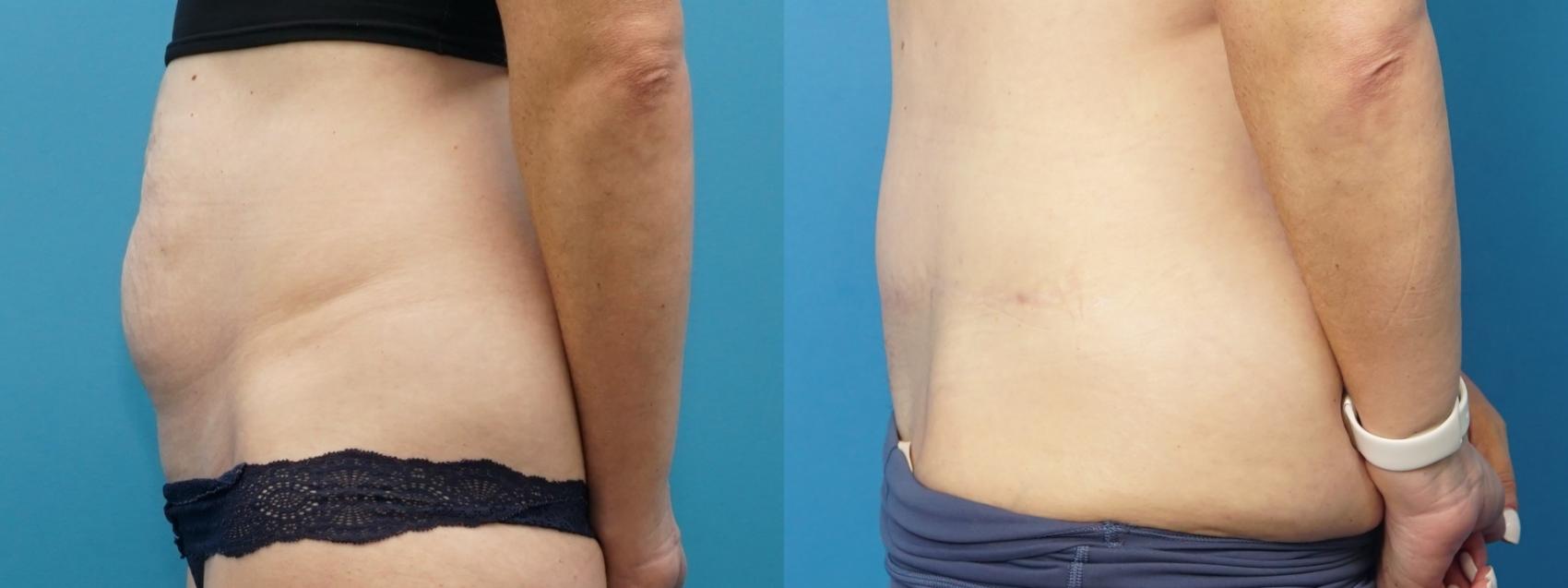 Before & After Abdominoplasty/Tummy Tuck Case 377 Left Side View in North Shore, IL