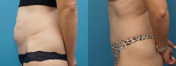 Before & After Abdominoplasty/Tummy Tuck Case 377 Left Side View in North Shore, IL
