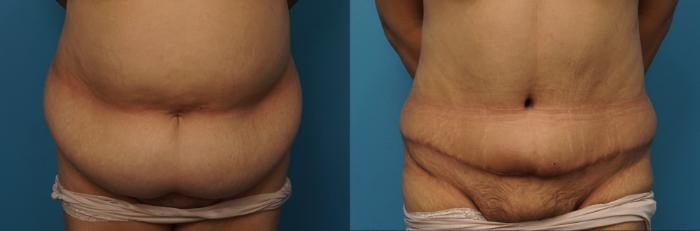 Before & After Liposuction Case 398 Front View in North Shore, IL
