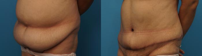 Before & After Liposuction Case 398 Left Oblique View in North Shore, IL