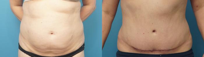 Before & After Abdominoplasty/Tummy Tuck Case 400 Front View in North Shore, IL