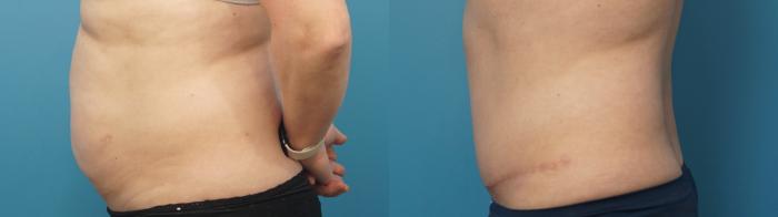 Before & After Abdominoplasty/Tummy Tuck Case 400 Left Side View in North Shore, IL